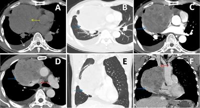 Case report: Primary mediastinal Ewing’s sarcoma presenting with chest tightness